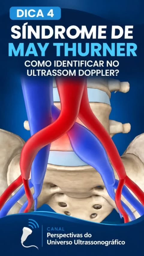 Post sobre a síndrome de May-Thurner no doppler venoso